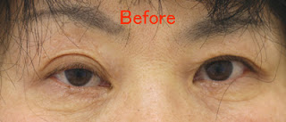 公式】鶴舞公園クリニック | 切らない眼瞼下垂手術（タッキング法）